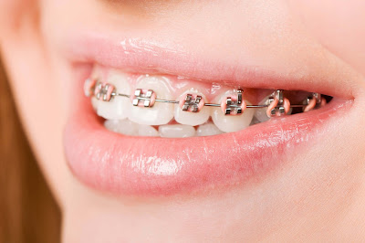 Niềng răng hô hàm trên có được không?