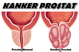 Penyebab dan Gejala Kanker Prostat