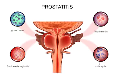 Prostata ingrossata