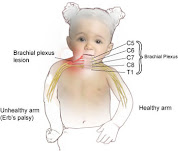 Erb's Palsy