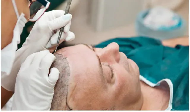 Is Hair Transplant Painful? hair transplant,hair transplant pain,is hair transplant painful,hair transplant results,fue hair transplant,hair transplant surgery,hair transplant painful or not,pain during hair transplant,how painful is hair transplant surgery,fue hair transplant pain,hair transplant in india,painful hair transplant,hair transplant before and after,hair transplant pain after surgery,pain in hair transplant,does hair transplant pain,is hair transplant surgery painful