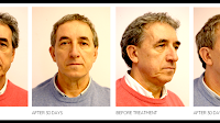 One Stitch Face Lift
