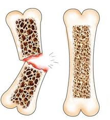 osteoporosis