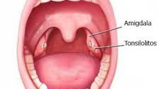 Causas Sintomas y Tratamiento para Combatir los Tonsilolitos