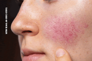 Treat Rosacea By Avoiding These 5 Triggers