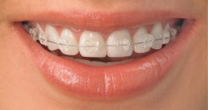 Quy trình thực hiện niềng răng mắc cài sứ