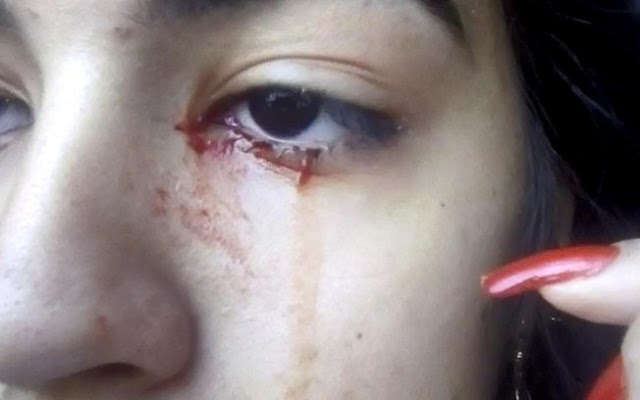 15-year-old allegedly cries blood and doctors have no idea why 