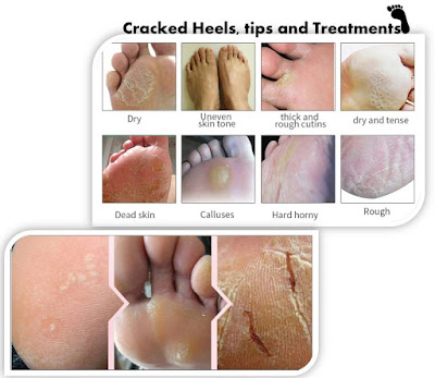 Cracked heels