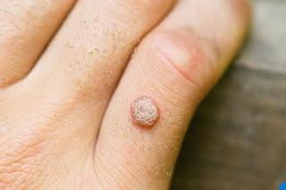 Choosing the Most Effective Wart Treatment for You