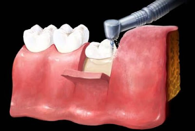 Cần làm gì với răng khôn mọc ngầm?