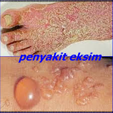 Obat Eksim Basah Di Kaki Tradisional 