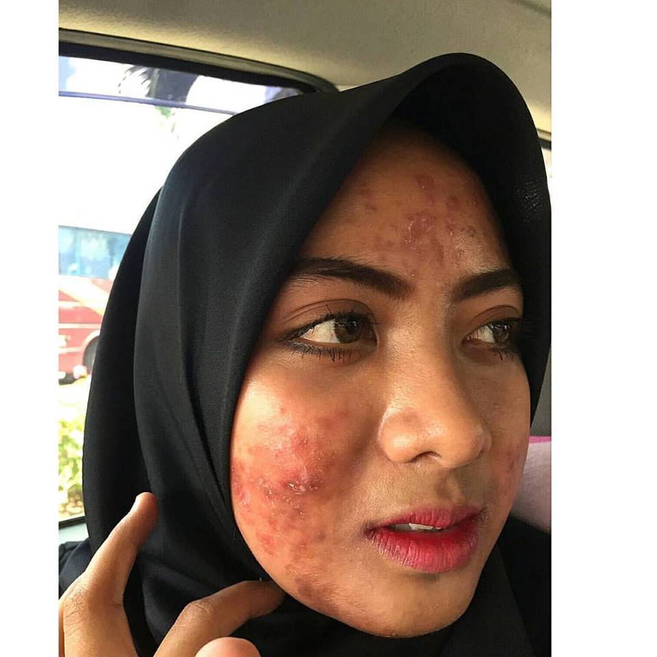 Inilah Gambar Muka Saya Semasa Breakout Tapi Dah Pulih 