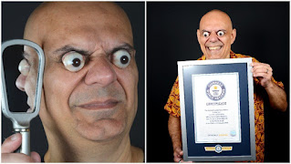 Alsorsa.News | Brasileiro quebra recorde de homem com olhos mais saltados do mundo