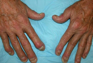 Psoriatic arthritis in homoeopathy