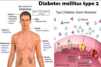 Cara mengobati Diabetes tipe-2