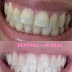 Produto revolucionário para restauração dos dentes. Veja o antes e o depois