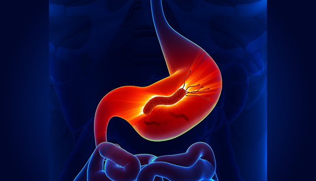 Helicobacter-pylori-úlceras-digestivas