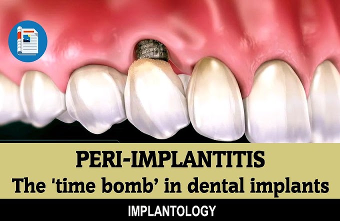 PERI-IMPLANTITIS: The 'time bomb’ in dental implants