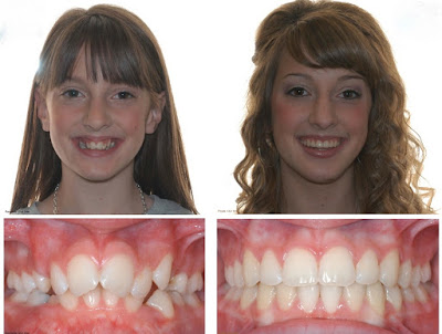 Hiệu quả niềng răng xong có đẹp hơn không?