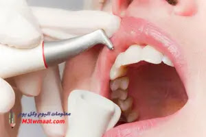 اصفرار الأسنان الأسباب والعلاج