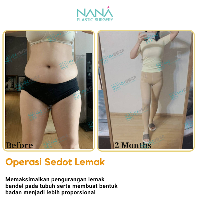 operasi plastik, operasi plastik korea, operasi sedot lemak, operasi liposuction, liposuction, lemak berlebih, badan gendut, langsing, diet, olahraga, bedah plastik, konsultasi, biaya operasi plastik, biaya operasi plastik korea, agen operasi plastik, agen operasi plastik korea