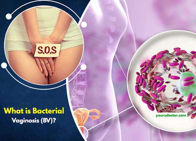Bacterial Vaginosis (BV): Causes, Symptoms, and Treatment
