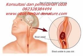 obat stroke herbal,obat herbal stroke,obat stroke denature,obat lumpuh separo,obat stroke ringan,obat stroke berat