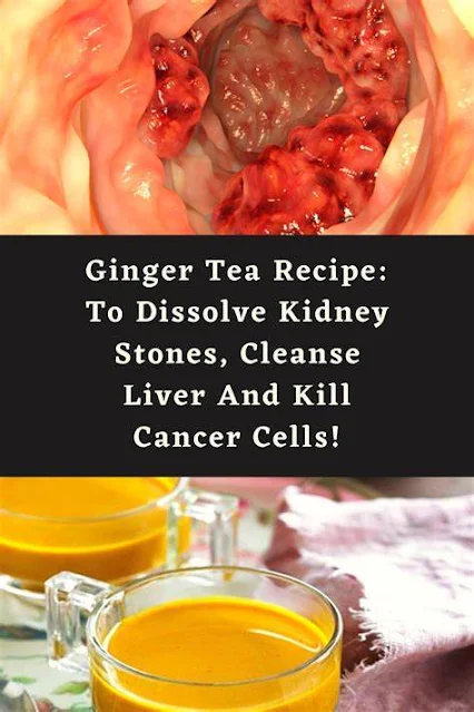 This Miracle Ginger Tea Dissolves Kidney Stones and Cleans the Liver