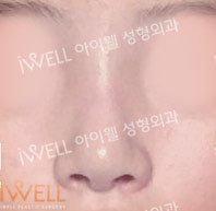 Rhinoplasty in Korea