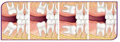 Nhổ răng khi niềng răng Invisalign