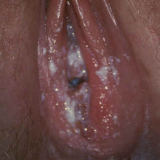 Vaginal Yeast Infection Pictures - 5