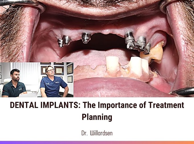 DENTAL IMPLANTS: The Importance of Treatment Planning - Dr. Willardsen