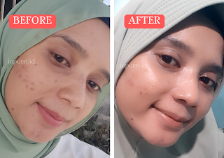 Before - Ater Pemakaian RoroMendut Exclusive Temulawak Anti-Acne Plus Brightening Herbal