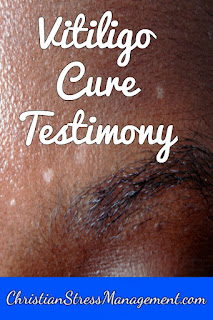 Vitiligo cure testimony