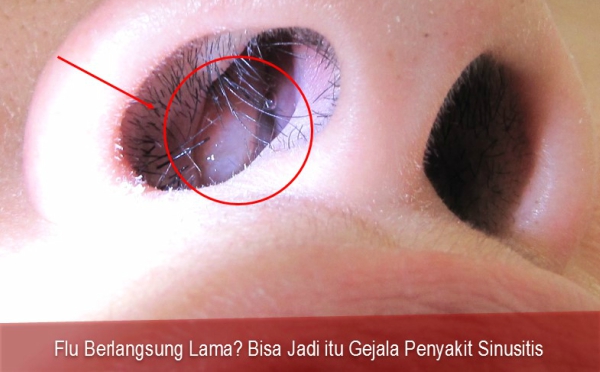 Flu Berlangsung Lama? Hati-hati, Bisa jadi itu Gejala Sinusitis!