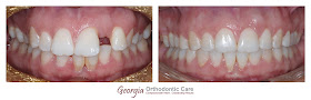 Space closing, space consolidation, diastema closing, restoratives, non extraction, missing teeth, extracted teeth, Orthodontics, orthodontists, Clear, Invisible, Braces, Invisalign, underbite,class III, face mask, non-surgery, non-extraction, crossbite, overbite, class II, crooked, spaced, crowding, teeth, severe, jaw alignment, cosmetics, implants, children, dentists, dentistry, friendly, adults, children, family, Lawrenceville, Norcross, Buford, Hamilton Mill, Dacula, Auburn, Sugar Hill, Sugar Loaf, Doraville, Chamblee, Stone Mountain, Decatur, Collins Hill, Snellville, Suwanee, Grayson, Lilburn, Duluth, Cumming, Alpharetta, Marietta, Dekalb, Gwinnett, County, Atlanta, North Georgia, GA, Georgia, 30043, 30093, affordable, Vietnamese, Spanish, weekend, Saturday, appointments, Dr. Quang Nguyen, Georgia Orthodontic Care, Nguyen Orthodontics.