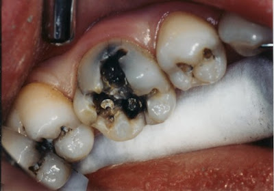 Những sai lầm thường gặp khi mắc bệnh sâu răng