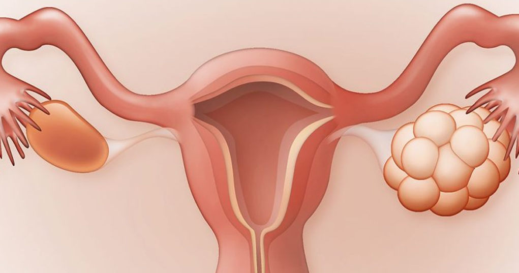  هل تكيس المبايض يمنع الحمل؟ ونصائح للتغلب على ذلك