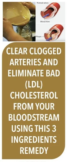 Clear Clogged Arteries And Eliminate Bad (Ldl) Cholesterol From Your Bloodstream Using This 3 Ingredients Remedy