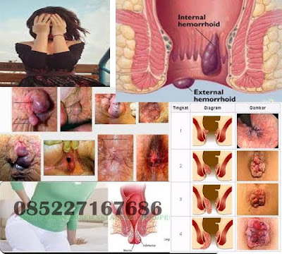  Pengetahuan tentang wasir / hemorroid dan penanganannya