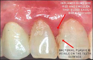 Gingivitis adalah