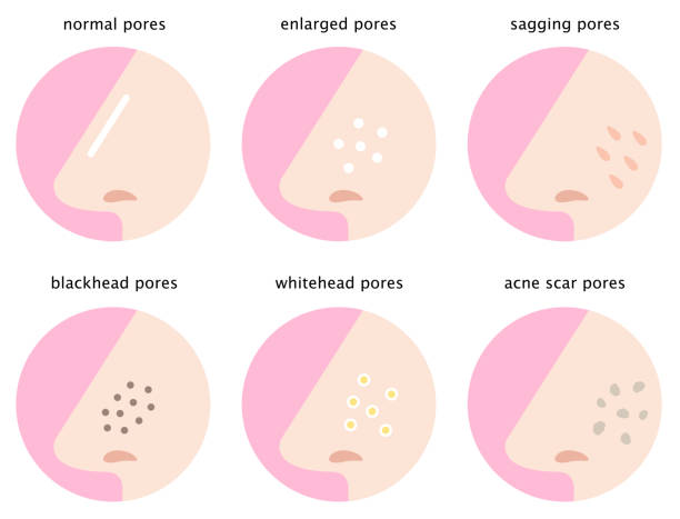 types of open pores