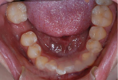 Làm chắc răng cấm bằng phương pháp nha khoa 