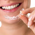 Các thông tin niềng răng bằng nhựa dẻo khách hàng cần biết