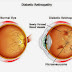 How Diabetes Affects The Eye And Vision?