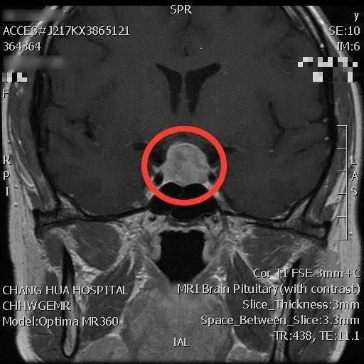 未懷孕狂分泌乳汁、視野縮小 確診腦下垂體良性腫瘤作祟