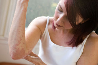 Allergy Characteristics