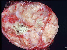 Fibrosarcoma