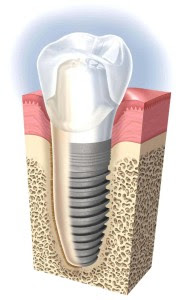 Dental implants in Gurgaon