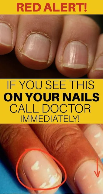 Red Alert: If You See This On Your Nails Immediately Visit A Doctor !